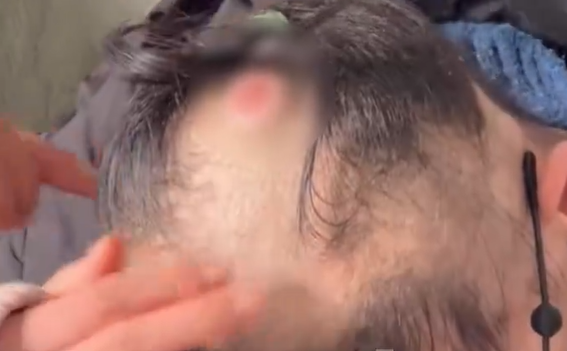 24岁女子持续咳嗽后查出肺癌，60岁父亲1天干活20小时筹钱，哥哥：“大不了不成家，我一定要救我妹妹！”